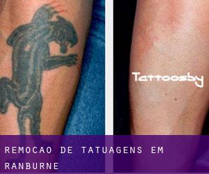 Remoção de tatuagens em Ranburne