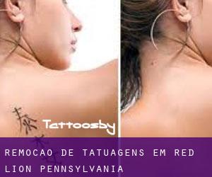 Remoção de tatuagens em Red Lion (Pennsylvania)