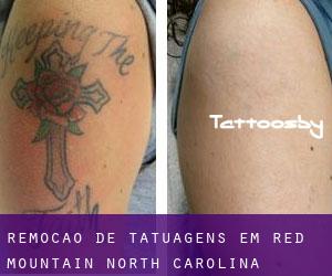 Remoção de tatuagens em Red Mountain (North Carolina)