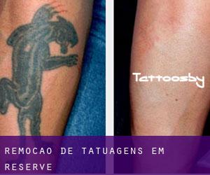 Remoção de tatuagens em Reserve