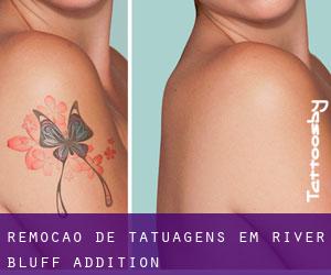 Remoção de tatuagens em River Bluff Addition