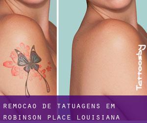 Remoção de tatuagens em Robinson Place (Louisiana)