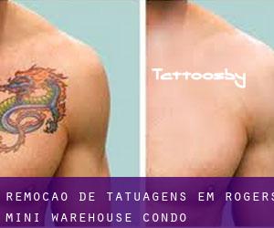 Remoção de tatuagens em Rogers Mini Warehouse Condo