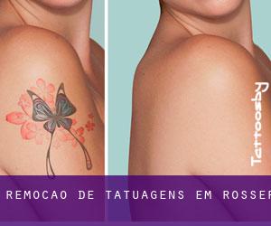 Remoção de tatuagens em Rosser