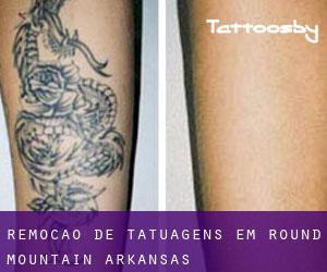 Remoção de tatuagens em Round Mountain (Arkansas)