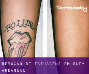 Remoção de tatuagens em Rudy (Arkansas)
