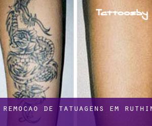Remoção de tatuagens em Ruthin