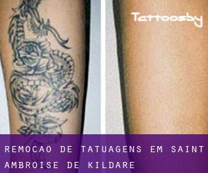 Remoção de tatuagens em Saint-Ambroise-de-Kildare