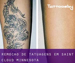 Remoção de tatuagens em Saint Cloud (Minnesota)