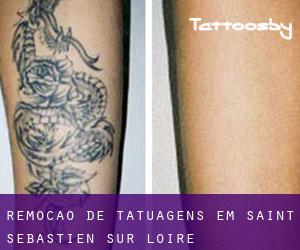 Remoção de tatuagens em Saint-Sébastien-sur-Loire