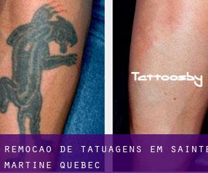 Remoção de tatuagens em Sainte-Martine (Quebec)