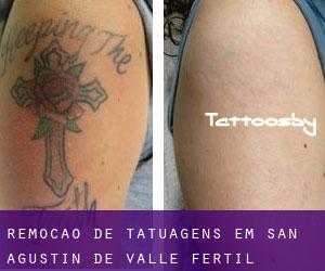 Remoção de tatuagens em San Agustín de Valle Fértil