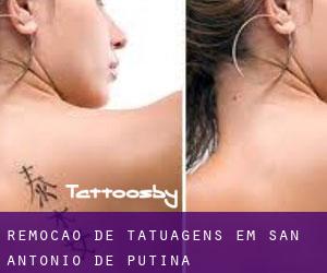 Remoção de tatuagens em San Antonio De Putina