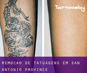 Remoção de tatuagens em San Antonio Province
