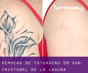 Remoção de tatuagens em San Cristóbal de La Laguna