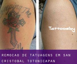 Remoção de tatuagens em San Cristóbal Totonicapán