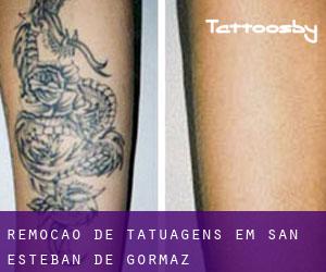 Remoção de tatuagens em San Esteban de Gormaz