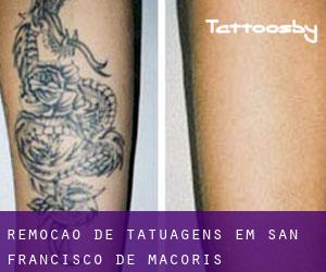 Remoção de tatuagens em San Francisco de Macorís