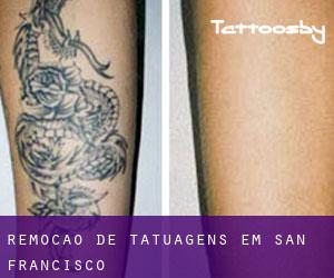 Remoção de tatuagens em San Francisco