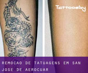 Remoção de tatuagens em San José de Aerocuar