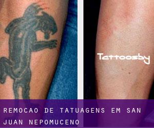 Remoção de tatuagens em San Juan Nepomuceno
