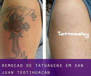 Remoção de tatuagens em San Juan Teotihuacán