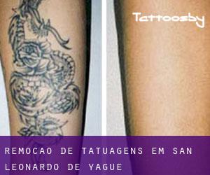 Remoção de tatuagens em San Leonardo de Yagüe