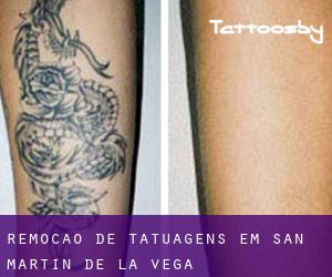 Remoção de tatuagens em San Martín de la Vega