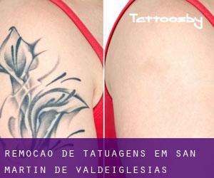 Remoção de tatuagens em San Martín de Valdeiglesias