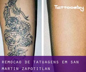 Remoção de tatuagens em San Martín Zapotitlán