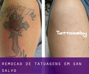 Remoção de tatuagens em San Salvo