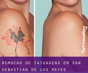 Remoção de tatuagens em San Sebastián de los Reyes