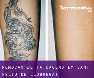 Remoção de tatuagens em Sant Feliu de Llobregat