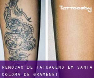 Remoção de tatuagens em Santa Coloma de Gramenet