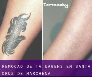 Remoção de tatuagens em Santa Cruz de Marchena