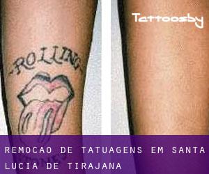 Remoção de tatuagens em Santa Lucía de Tirajana