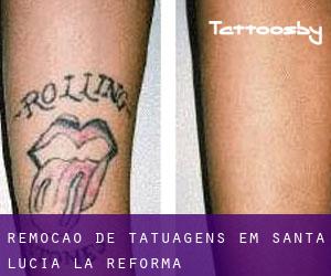 Remoção de tatuagens em Santa Lucía La Reforma