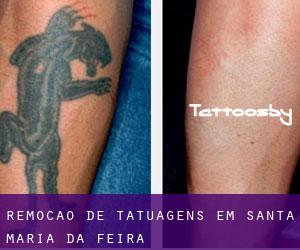 Remoção de tatuagens em Santa Maria da Feira
