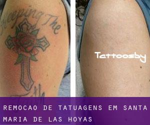 Remoção de tatuagens em Santa María de las Hoyas