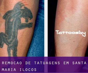 Remoção de tatuagens em Santa Maria (Ilocos)