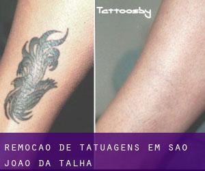 Remoção de tatuagens em São João da Talha