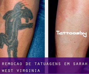 Remoção de tatuagens em Sarah (West Virginia)