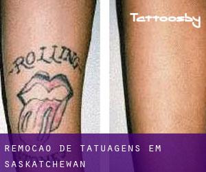 Remoção de tatuagens em Saskatchewan