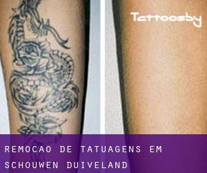 Remoção de tatuagens em Schouwen-Duiveland