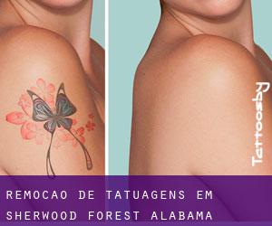 Remoção de tatuagens em Sherwood Forest (Alabama)