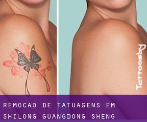 Remoção de tatuagens em Shilong (Guangdong Sheng)
