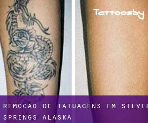 Remoção de tatuagens em Silver Springs (Alaska)