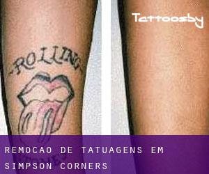 Remoção de tatuagens em Simpson Corners