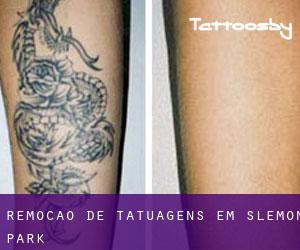 Remoção de tatuagens em Slemon Park