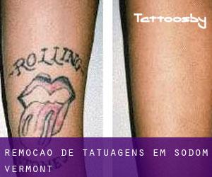 Remoção de tatuagens em Sodom (Vermont)